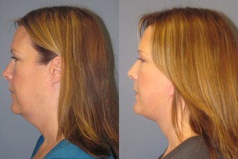 Lite Lift, liposuction of the neck, blue peel