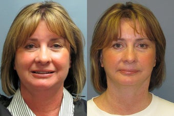 Lite Lift, liposuction of the neck