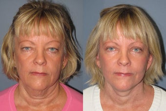 Lite Lift, Liposuction of the neck, eyelid lift