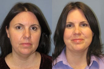 Lite Lift™, liposuction of the neck