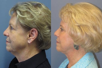 Lite Lift™, brow lift, liposuction of the nec, neck lift, blue peel