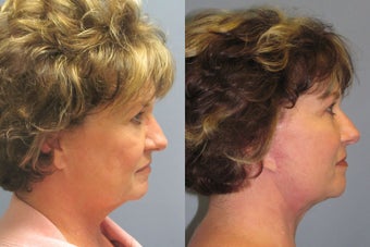 Lite Lift™, neck lift, liposuction of the neck