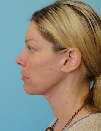 Facelift