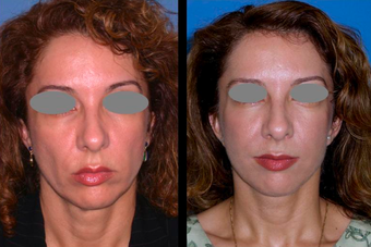 Mid-face (cheek) lift and mini-facelift