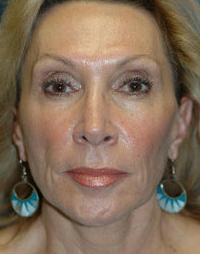 Mini Lift and Injectable Fillers