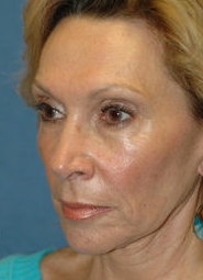 Mini Lift Surgery and Injectable Fillers
