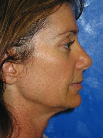 Mini Face lift