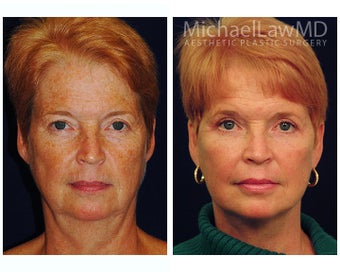 Facial Rejuvenation