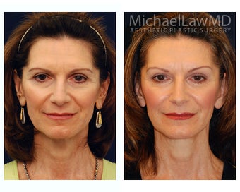 Facial Rejuvenation