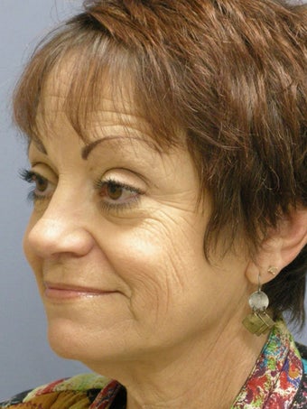 Lite Lift, Brow Lift