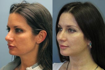 Lite Lift, Brow Lift