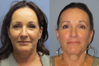 Lite Lift, Liposuction of the  neck