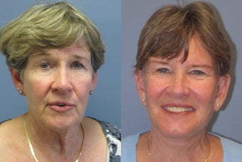 Lite lift, Neck Lift, Brow Lift