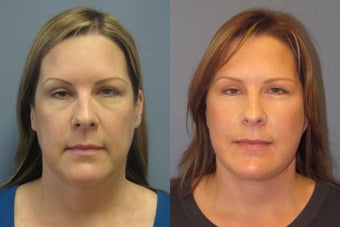 Lite Lift, liposuction of the neck, blue peel