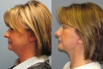Lite Lift, liposuction of the neck