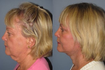 Lite Lift, Liposuction of the neck, eyelid lift