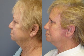 Lite Lift™, liposuction of the neck, brow lift, eyelid lift
