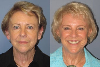 Lite Lift™, brow lift, liposuction of the nec, neck lift, blue peel