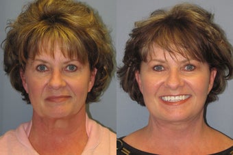 Lite Lift™, neck lift, liposuction of the neck
