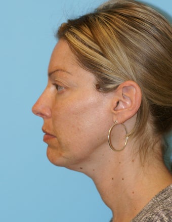 Facelift