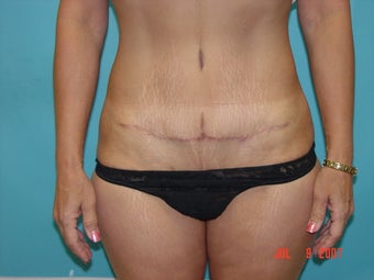 mini tummy tuck