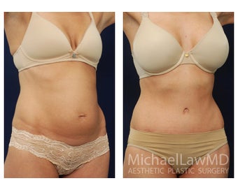 Abdominoplasty - Tummy Tuck