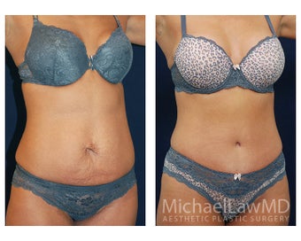 Abdominoplasty - Tummy Tuck