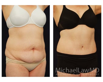 Abdominoplasty - Tummy Tuck