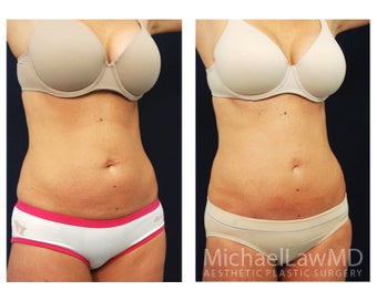 Abdominoplasty - Tummy Tuck