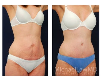 Abdominoplasty - Tummy Tuck