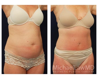 Abdominoplasty - Tummy Tuck