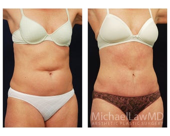 Abdominoplasty - Tummy Tuck