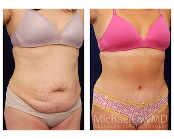 Abdominoplasty - Tummy Tuck