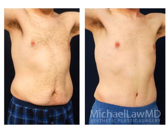Abdominoplasty - Tummy Tuck