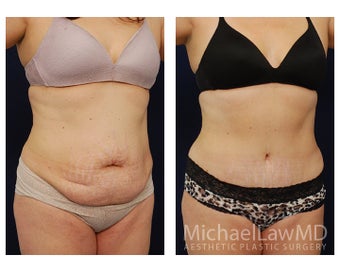 Abdominoplasty - Tummy Tuck