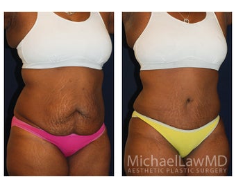 Abdominoplasty - Tummy Tuck