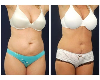Abdominoplasty - Tummy Tuck