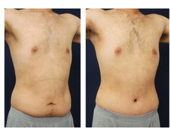 Abdominoplasty - Tummy Tuck