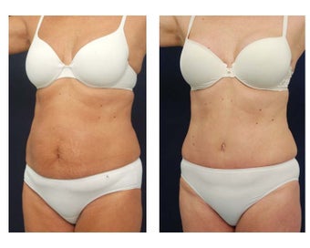 Abdominoplasty - Tummy Tuck