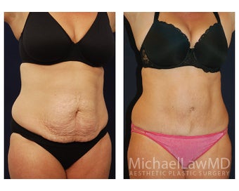 Abdominoplasty - Tummy Tuck