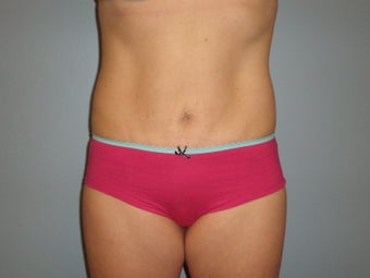 Mini Tummy Tuck 