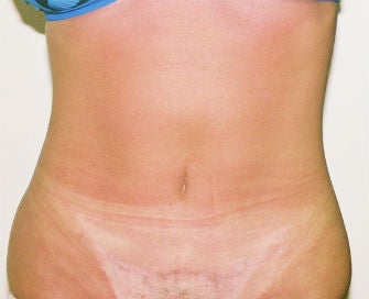 Mini-abdominoplasty