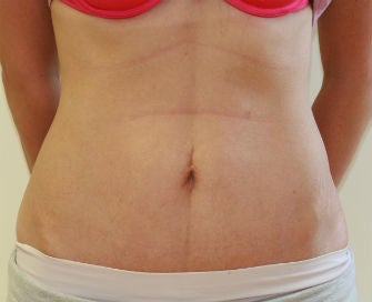 Mini-abdominoplasty