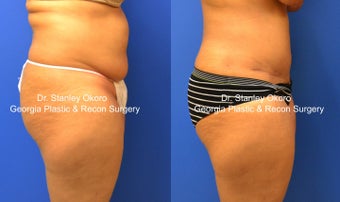 Mini Tummy Tuck