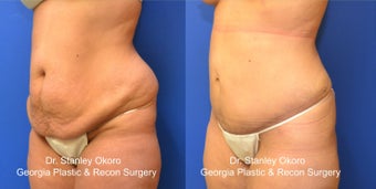 Mini Tummy Tuck