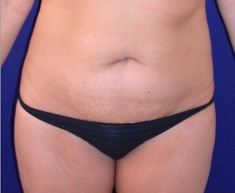 Mini Tummy Tuck