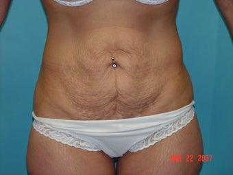 mini tummy tuck