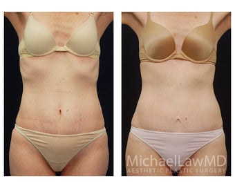 Abdominoplasty - Tummy Tuck