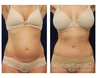 Abdominoplasty - Tummy Tuck