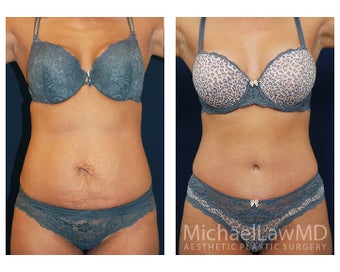 Abdominoplasty - Tummy Tuck